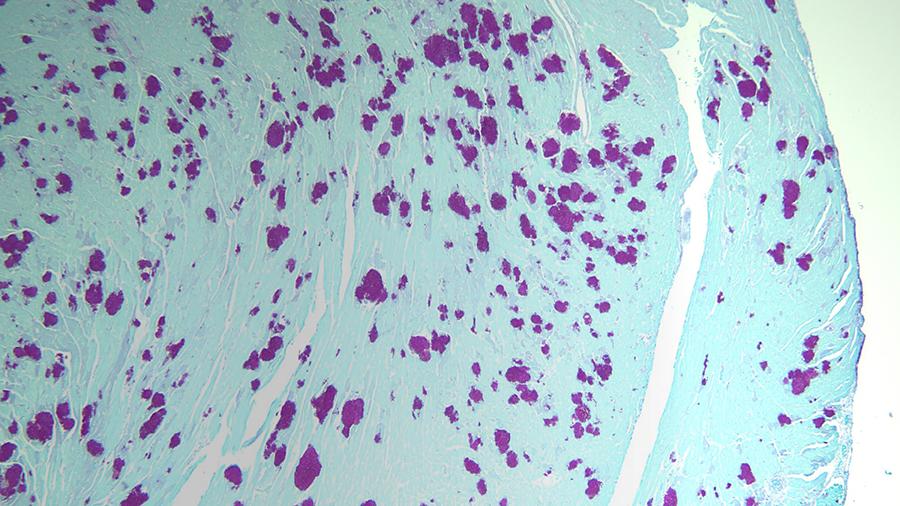 Heart Candida Periodic Acid Schiff Stain